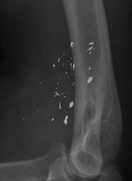 elbow.jpg