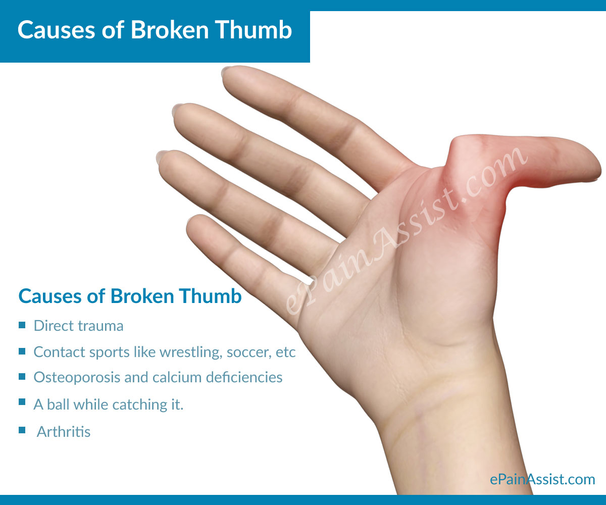 Causes-of-Broken-Thumb.jpg