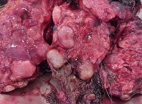 Dovel_hydatid_cysts_1.jpg